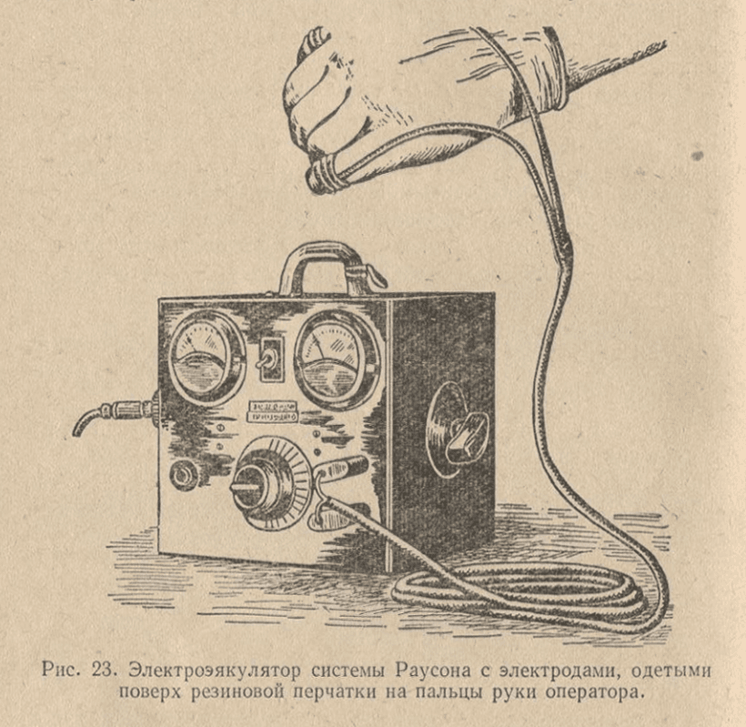 Электроэякулятор системы Раусона с электродами, одетыми поверх резиновой перчатки на пальцы руки оператора