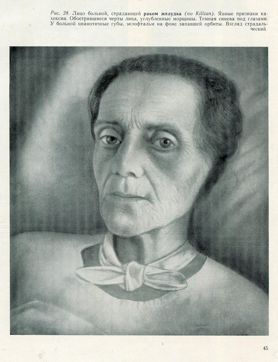 Рис. 28. Лицо больной, страдающей раком желудка (по Killian). Явные признаки кахексии. Обострившиеся черты лица, углубленные морщины. Темная синева под глазами. У больной цианотичные губы, экзофтальм на фоне запавшей орбиты. Взгляд страдальческий.